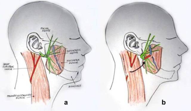 神经移植桥接术示意。资料图片  