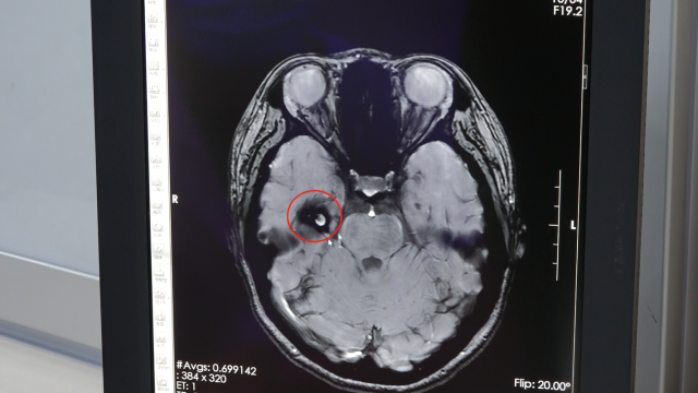 影像检查提示右侧颞叶占位性病变。  受访者供图