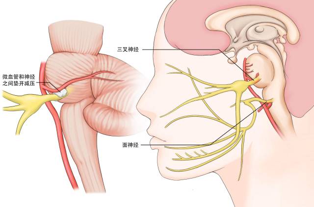 微血管减压手术示意。 制图：吕峰  