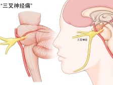 三叉神经痛到怀疑人生？内镜下微血管减压术解忧
