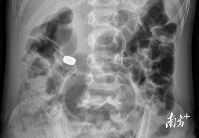 影像检查结果显示电池在胃部。