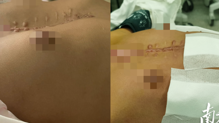 女童先心病术后继发胸廓畸形，Wung手术矫正后恢复正常