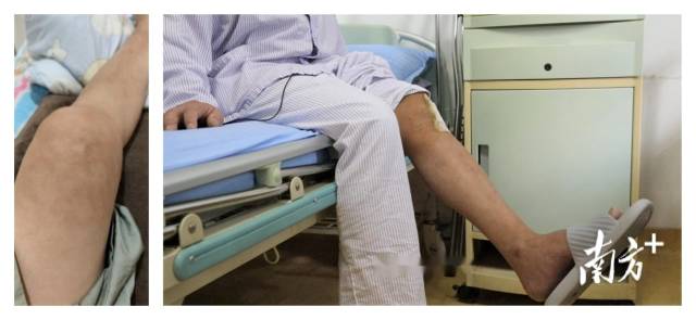 凌先生入院时关节肿痛（图左），出院时患肢已能屈伸（图右）。  