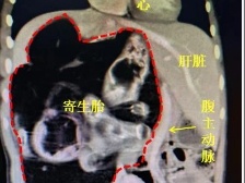 女童肚藏罕见寄生胎 ，专家巧手保血管卸瘤