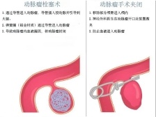 女子突发脑出血，她的这个习惯很多人都有……