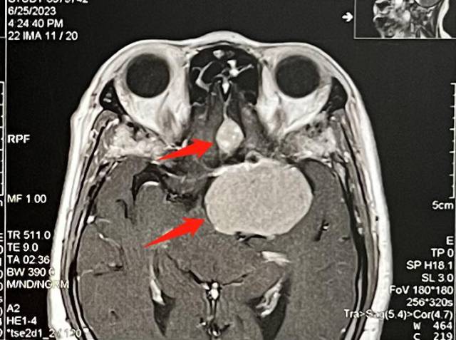 术前影像提示：左侧床突旁（下方）及左侧嗅沟（上方）占位性病变。  受访者供图