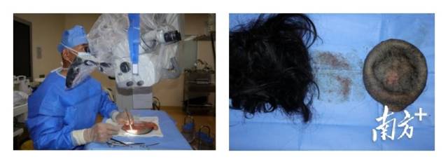 刘族安进行术前预处理，剃除撕脱头皮毛发并进行消毒、血管标记。  受访者供图