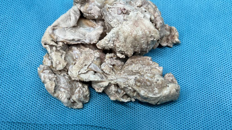 男子尿道塞异物 膀胱长出大结石
