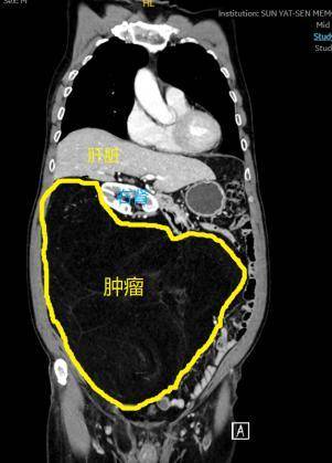 影像检查显示，“巨无霸”肿瘤几乎占据整个腹腔。  受访者供图