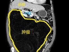 七旬阿伯“挺肚”三年 ，手术卸下脂肪肉瘤15斤