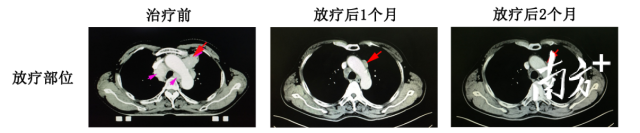 立体定向放疗联合免疫治疗后全身肿瘤消退。  受访者供图