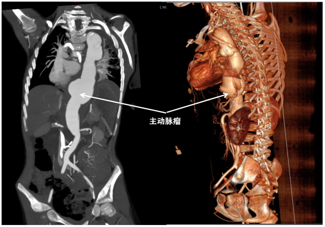 影像清晰显示主动脉瘤。  受访者供图