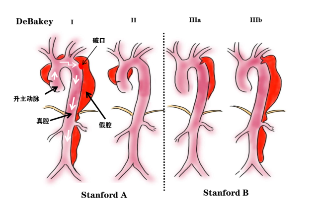 主动脉夹层临床分型示意图，DeBakey III型、Stanford B型为广泛型夹层，手术难度大风险高。  受访者供图