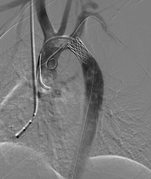 术中植入一枚覆膜支架。