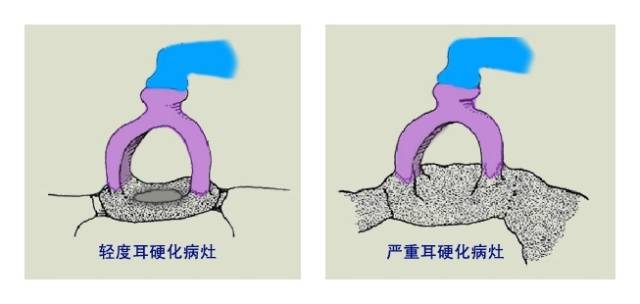 耳硬化病灶示意。 