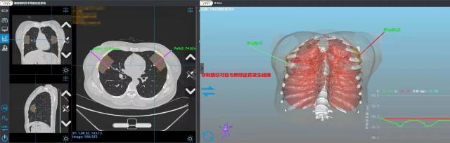 人工智能实现病灶结构三维重建并规划穿刺路径。  受访者供图