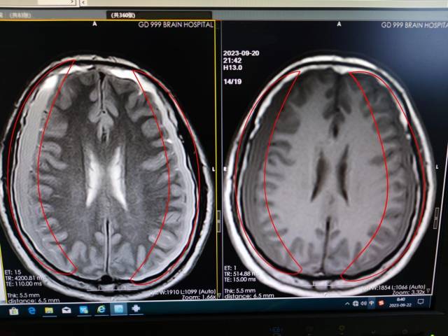 双侧额颞顶部硬膜下血肿形成。  受访者供图