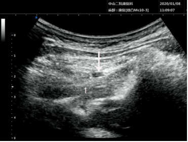 超声介入第2颈神经后支阻滞声像图。数字“1”为头下斜肌，白色箭头显示药液弥散。  受访者供图
