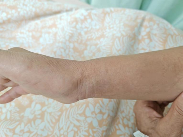 术后，李阿姨的手上几乎看不出痕迹。  受访者供图