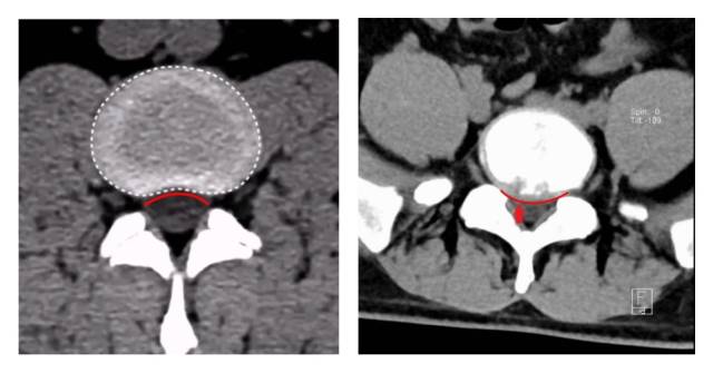 图左：正常腰间盘CT，椎体的后缘弧形向上。图右：小阳的腰间盘CT，椎体的后缘弧形向下，腰5/骶1椎间盘膨出并偏右后方突出。  受访者供图