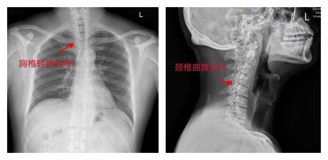 影像学资料显示胸椎轻度侧弯。  