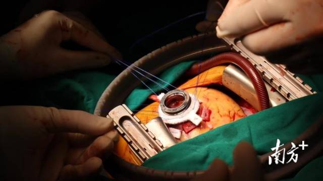 术中植入的左心室辅助系统。  受访者供图