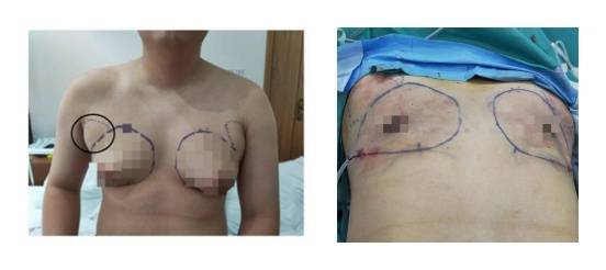 阿明手术前后对比。  受访者供图