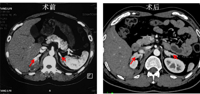 李先生术后残留的肾上腺组织出现明显增粗。  受访者供图