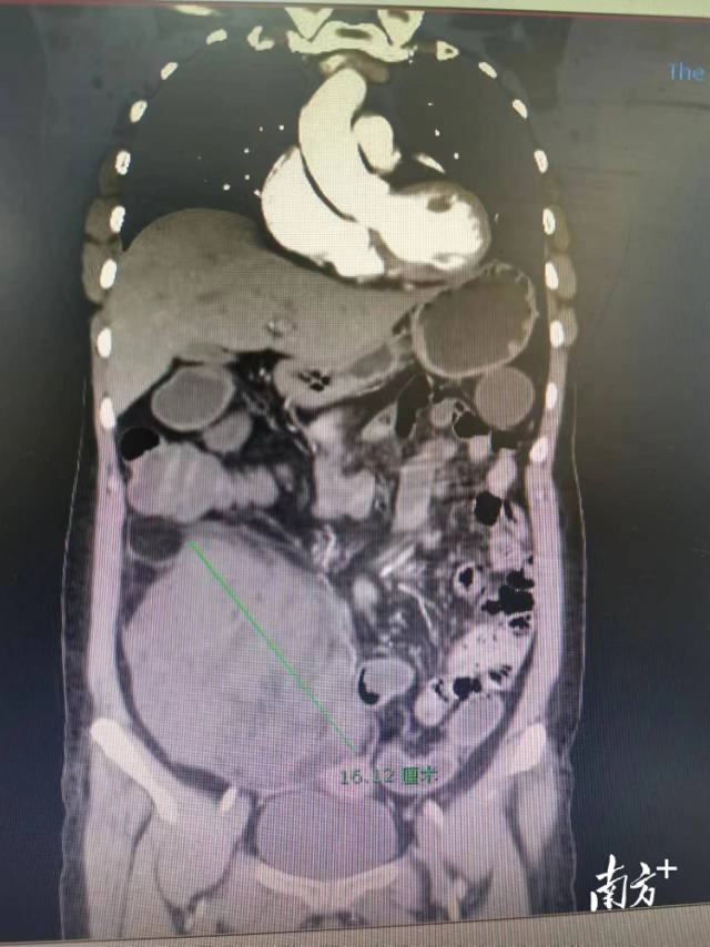 检查显示肿瘤的位置。