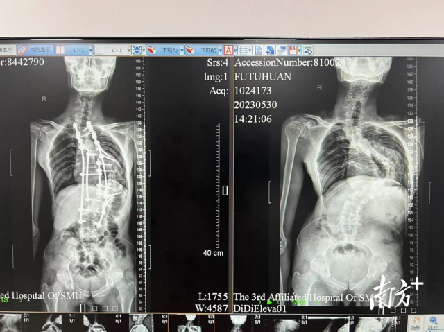 手术前后对比（右为手术前）