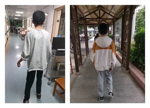 患儿出入院对比，经康复治疗行走明显改善。  