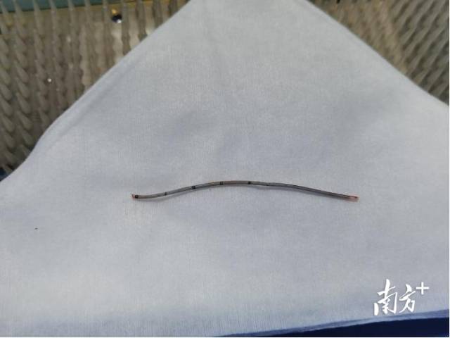 脱落到腹主动脉的脐动脉导管。  受访者供图