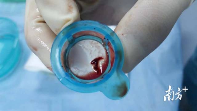 术中抽取的冠脉闭塞处血栓。  受访者供图