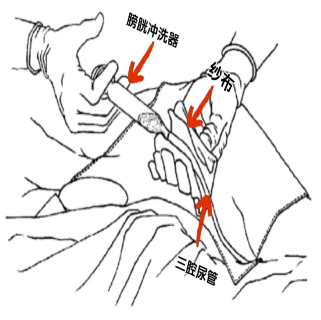 引流管冲洗用什么＞＞＂ id=＂articleTitle＂ data-columnid=＂43564＂ data-video-blur=＂1＂＞关于膀胱冲洗，你认识多少？_https://www.jmylbn.com_新闻资讯_第2张