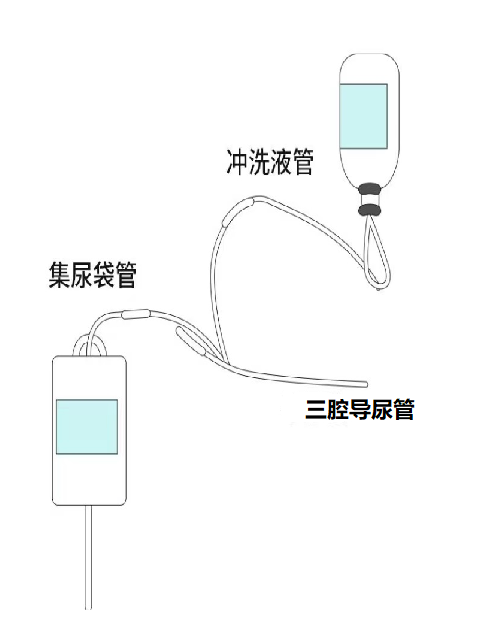 引流管冲洗用什么＞＞＂ id=＂articleTitle＂ data-columnid=＂43564＂ data-video-blur=＂1＂＞关于膀胱冲洗，你认识多少？_https://www.jmylbn.com_新闻资讯_第1张