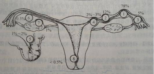 异位妊娠发生部位及概率：输卵管妊娠(1-4)、卵巢妊娠(7)、腹腔内妊娠(5)、阔韧带妊娠(7)、宫颈妊娠(8)。  受访者供图