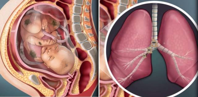 胎粪吸入肺部，将导致一系列严重后果。  受访者供图