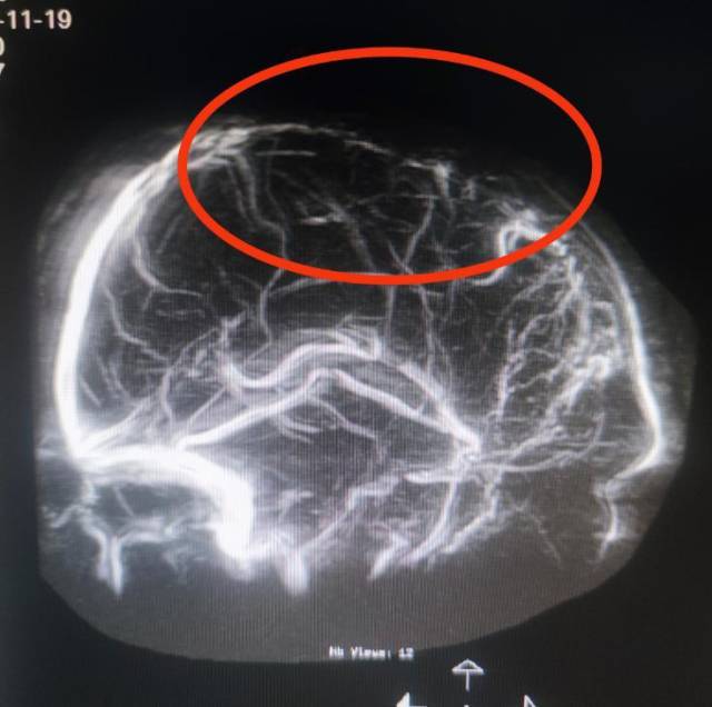 MRV（磁共振成像）结果显示上矢状窦中1/3次全闭塞。  受访者供图