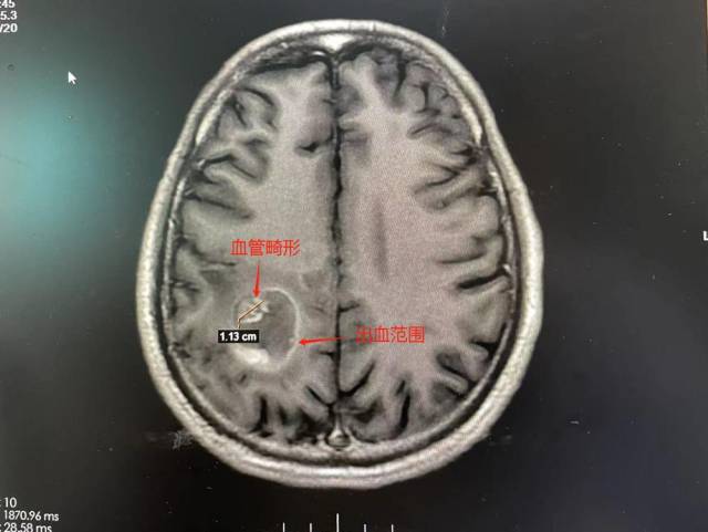患者MR影像。  受访者供图