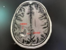 大爷腿脚无力吃狗肉“进补”，没想是脑血管畸形出血