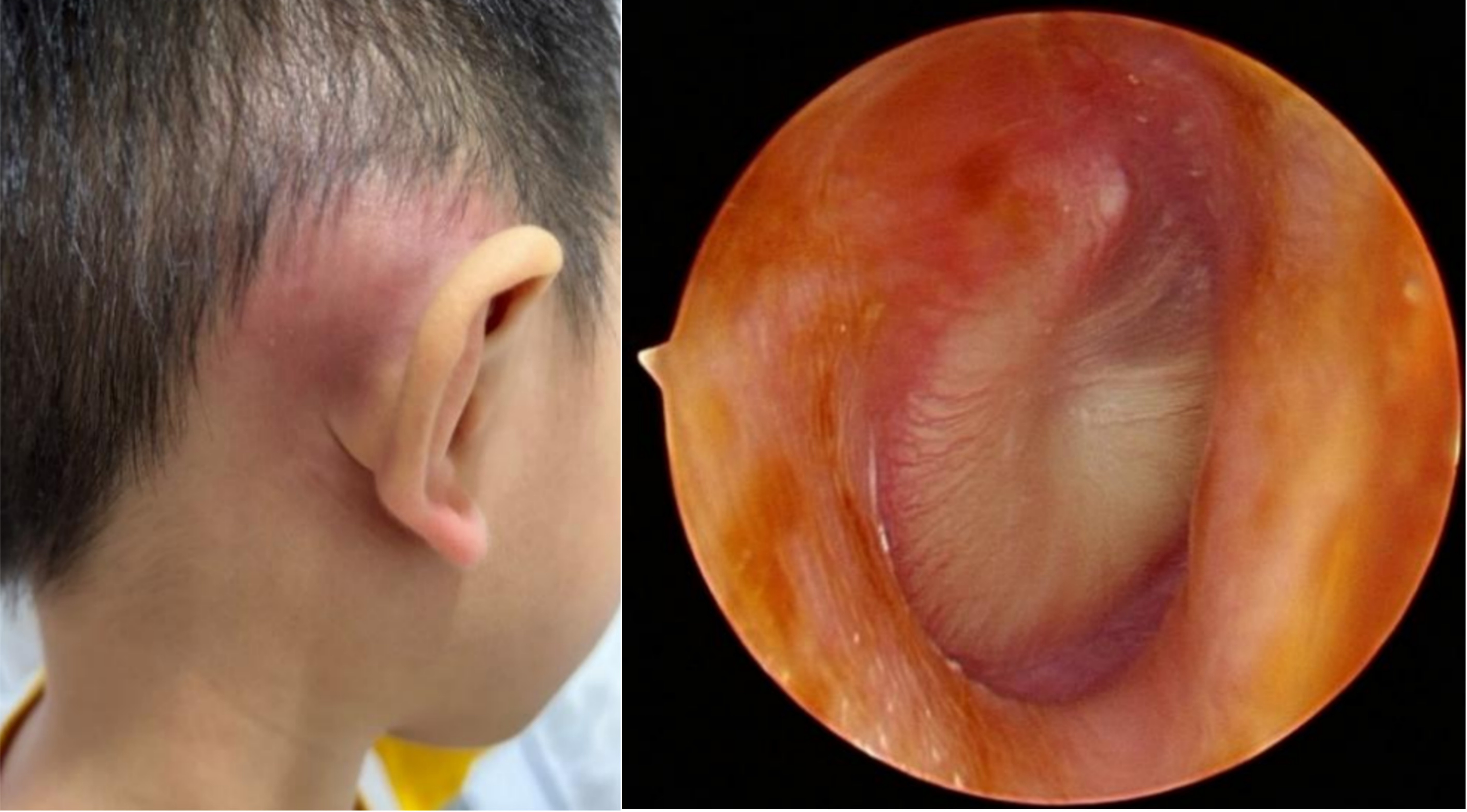 中耳炎诊断证明图片图片