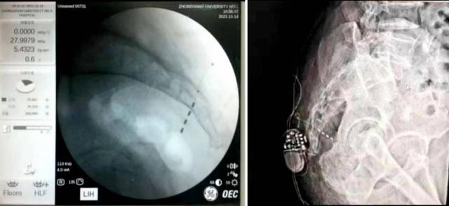 术中植入骶神经刺激器电极及植入骶神经刺激器。  受访者供图