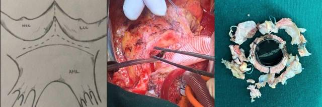 从左至右分别为：Y型切口的示意图；手术中Y型切口及缝合补片扩大瓣环；手术切下来的组织及机械瓣。  受访者供图