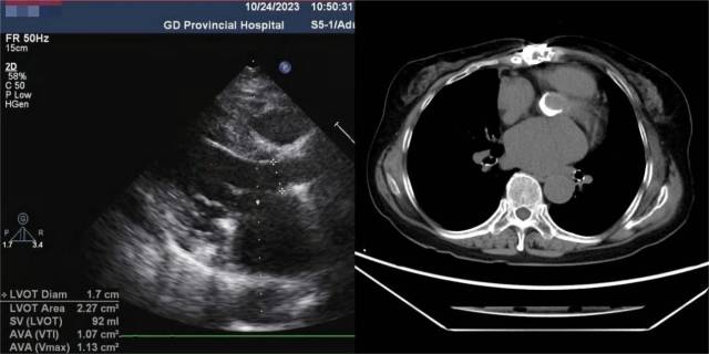 超声心动图、CT显示双瓣膜病变。  受访者供图