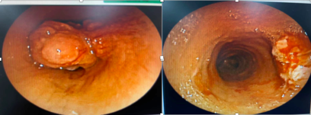 气管内肿瘤气管镜介入治疗前后对比。