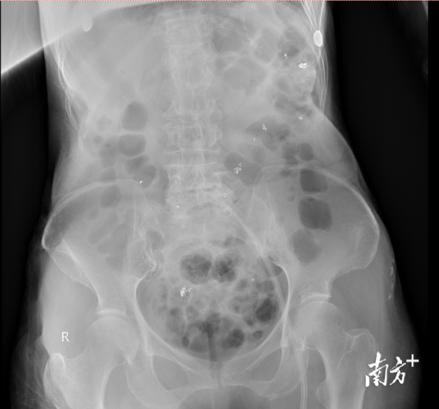 检查可以看到患者消化道内残留大量汞。