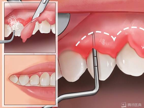 口腔ct怎么看坐月子不能刷牙？30多天不刷牙的深圳女子怎么样了……_https://www.jmylbn.com_新闻资讯_第4张