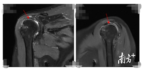 △图中箭头所示术后半年上关节囊重建后移植物位置良好。   