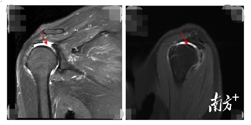 △术前MRI可见冈上肌完全断裂不可修复。