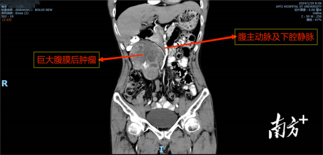 这颗巨大腹膜后肿瘤具有内分泌功能，能引起血压剧烈变化，成为患者体内的“定时炸弹”。